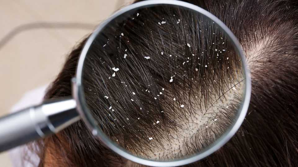 Dandruff Treatment