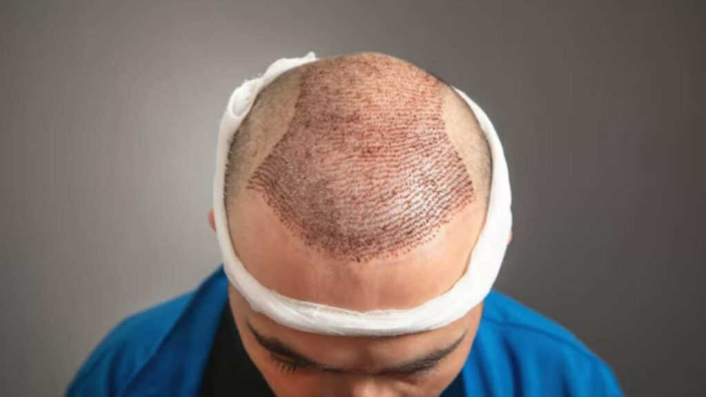Hair transplant clinic in Thodupuzha