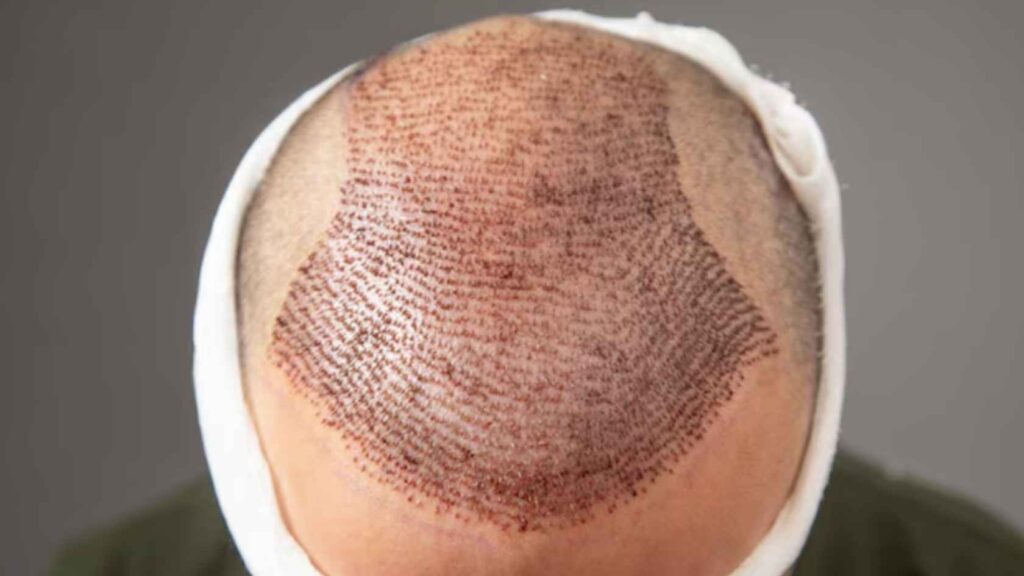 Hair Transplant Clinic Risks
