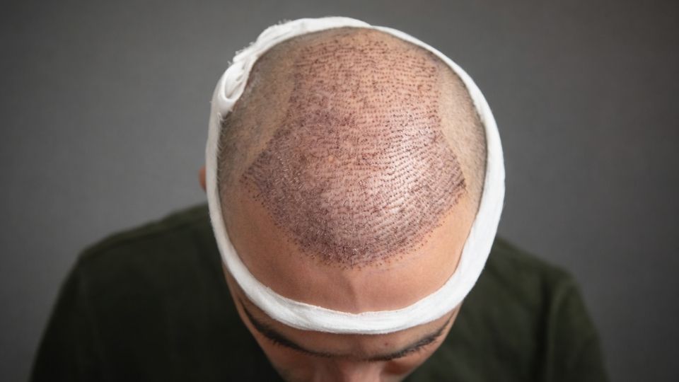 Hair Transplantation